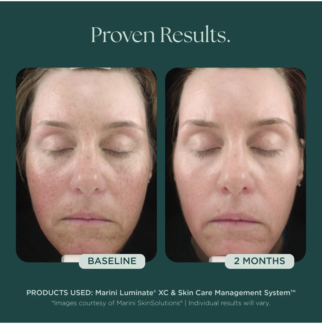 Marini Luminate XC before and after - 2 months