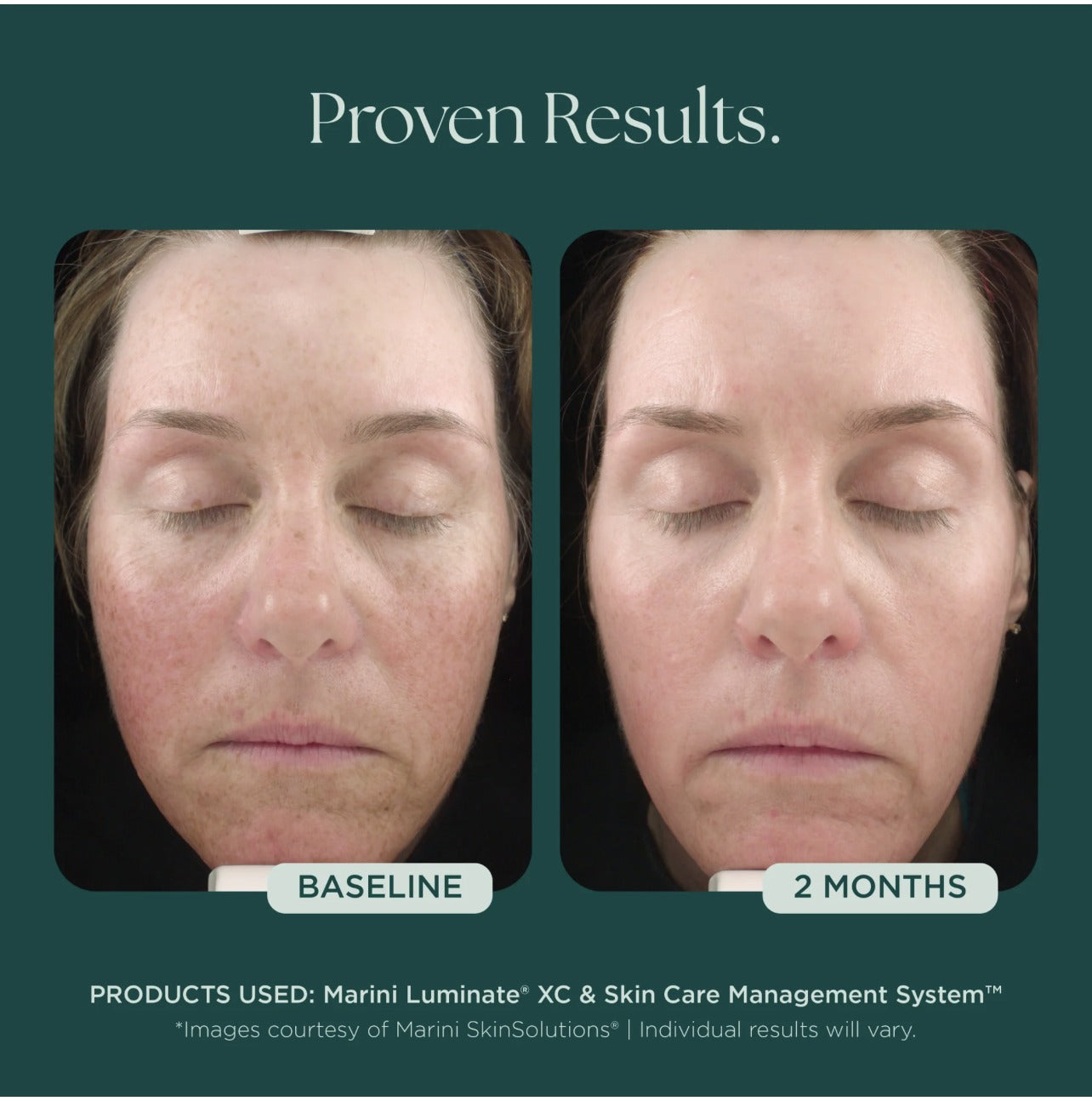 Marini Luminate XC before and after - 2 months
