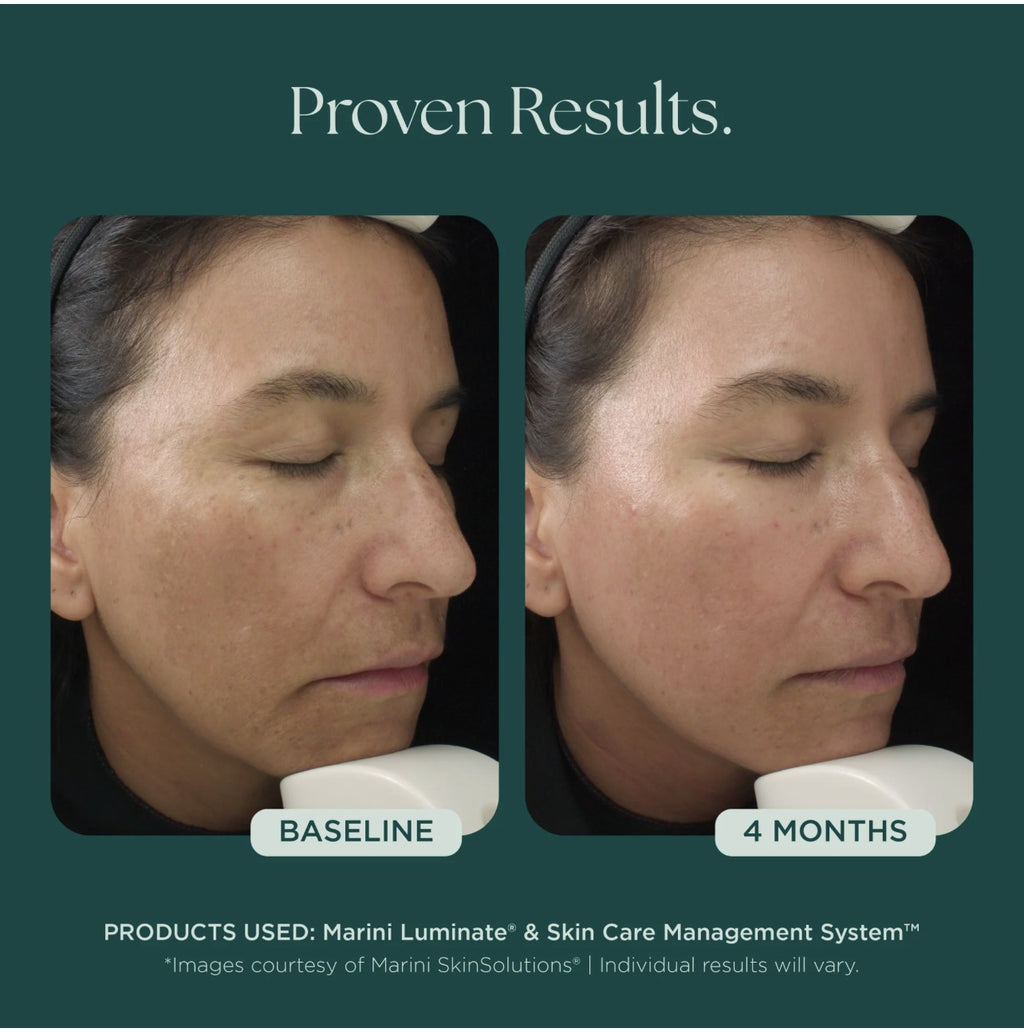 Marini Luminate XC before and after - 4 months